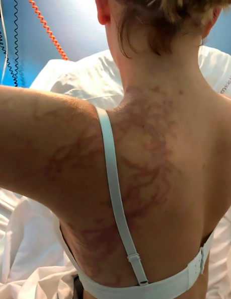 Jellyfish Attack: Woman was stung by deadly jellyfish