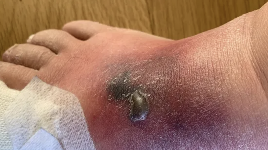 Brown Recluse Spider bite